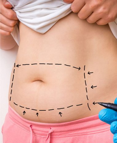 Abdominoplastie Geneva